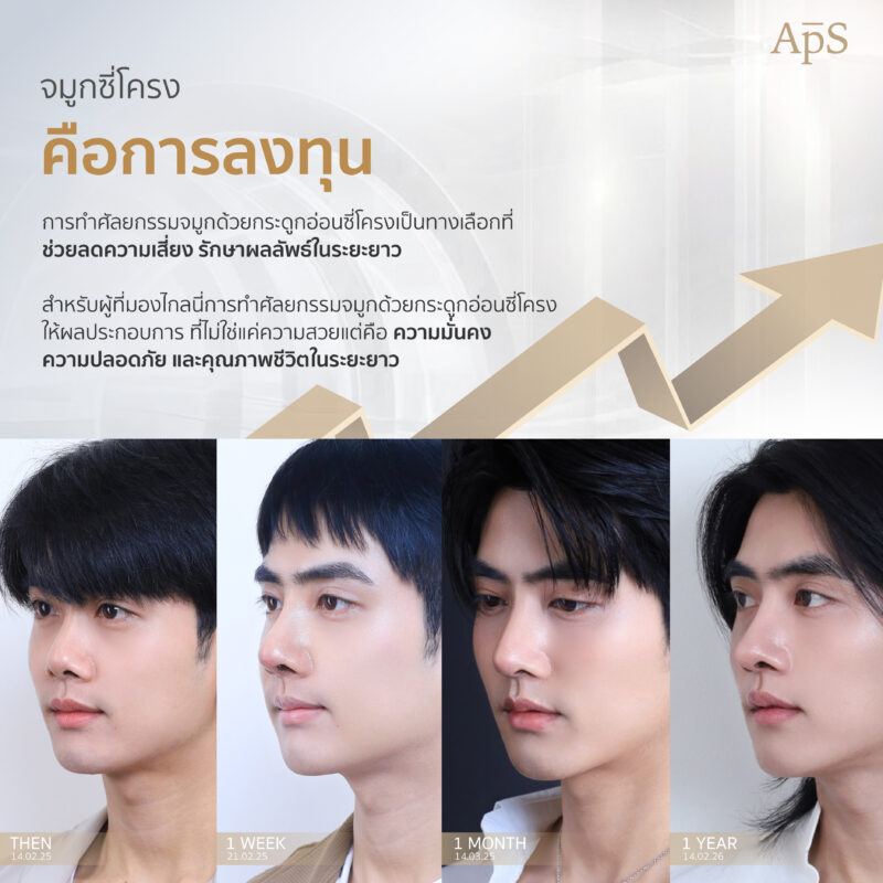 ใช้กระดูกซี่โครงทำจมูกคือการลงทุน