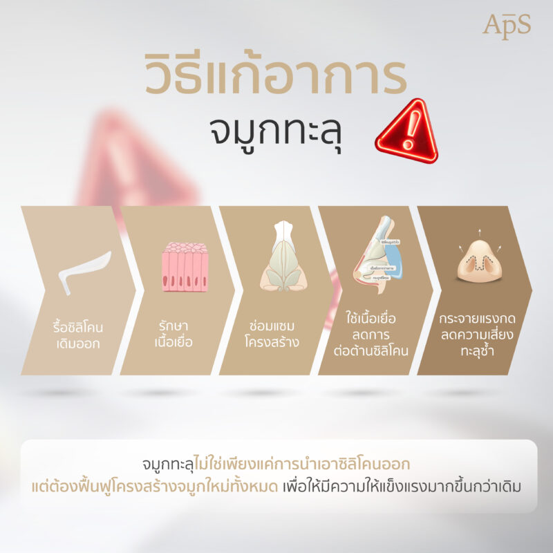 แก้จมูกทะลุโดยไม่อันตรายด้วยเทคนิค Open Rib Plus+ จาก APS Clinic