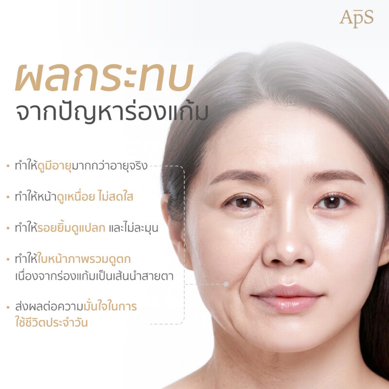 ปัญหาร่องแก้มส่งผลอย่างไรต่อใบหน้า?