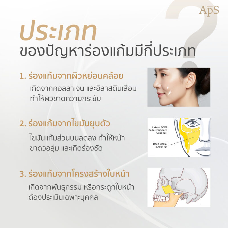 ร่องแก้มมีกี่ประเภท?