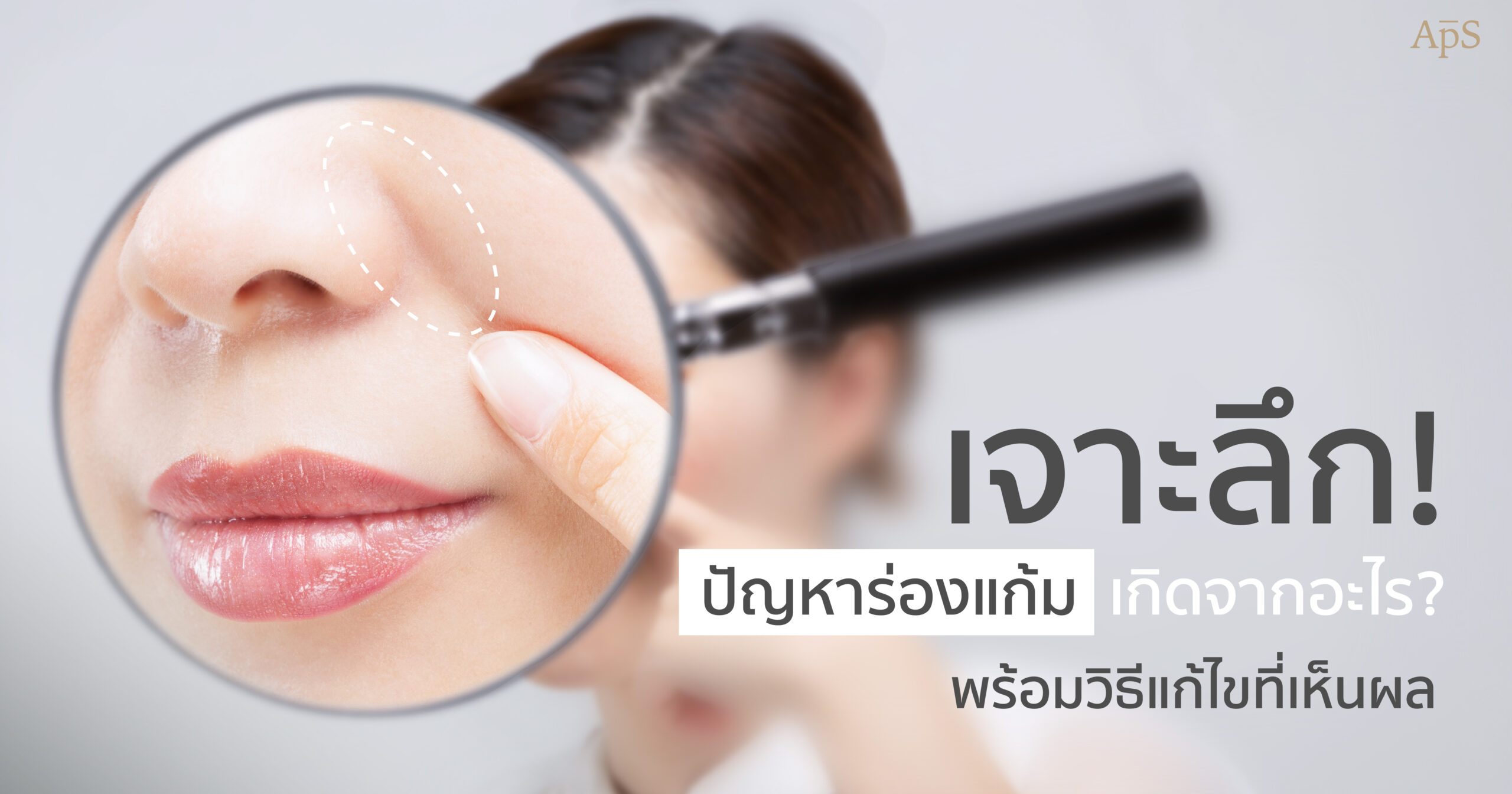 ร่องแก้มเกิดจากอะไร