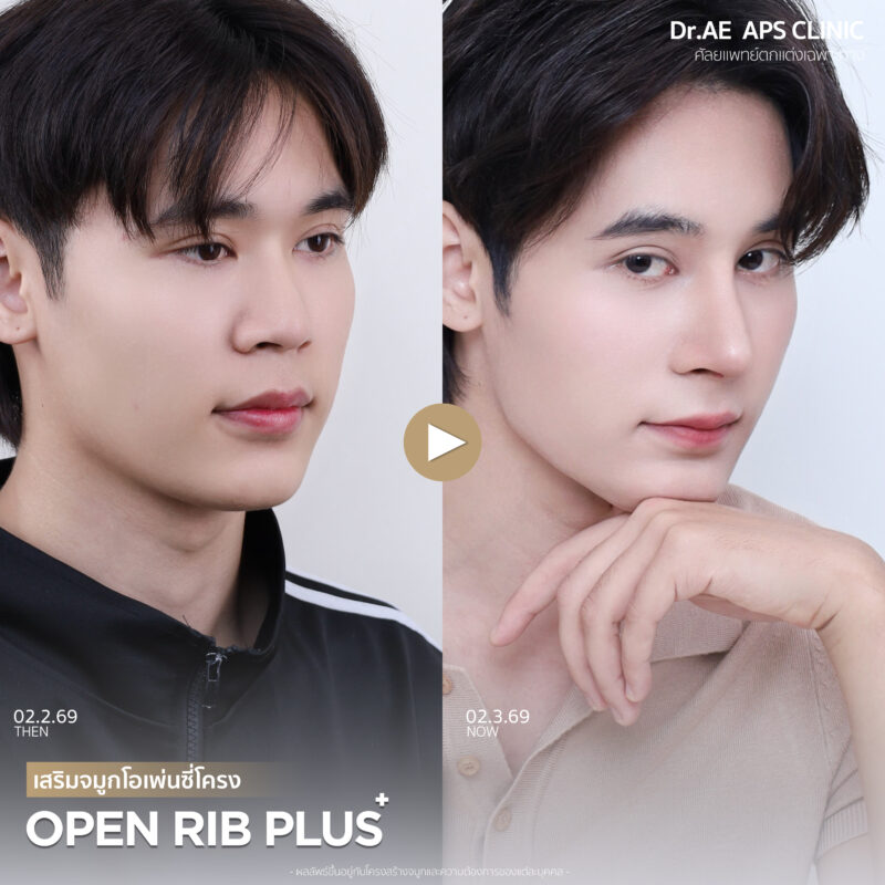 คุณฟลุ๊กรีวิวเสริมจมูกโอเพ่นซี่โครง Open rib plus+ จากคนแอบกังวล สู่คนที่ส่องกระจกทั้งวัน 9 รีวิวเสริมจมูกโอเพ่นซี่โครง คุณฟลุ๊ก