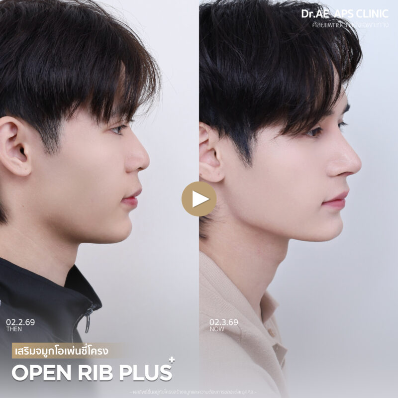 คุณฟลุ๊กรีวิวเสริมจมูกโอเพ่นซี่โครง Open rib plus+ จากคนแอบกังวล สู่คนที่ส่องกระจกทั้งวัน 8 รีวิวเสริมจมูกโอเพ่นซี่โครง คุณฟลุ๊ก