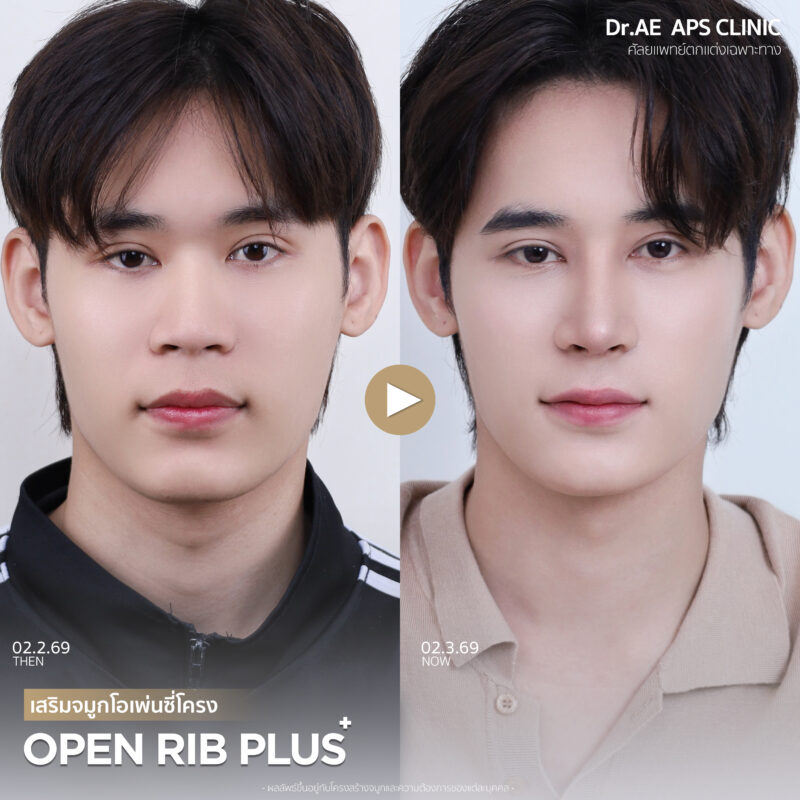 คุณฟลุ๊กรีวิวเสริมจมูกโอเพ่นซี่โครง Open rib plus+ จากคนแอบกังวล สู่คนที่ส่องกระจกทั้งวัน 7 รีวิวเสริมจมูกโอเพ่นซี่โครง คุณฟลุ๊ก