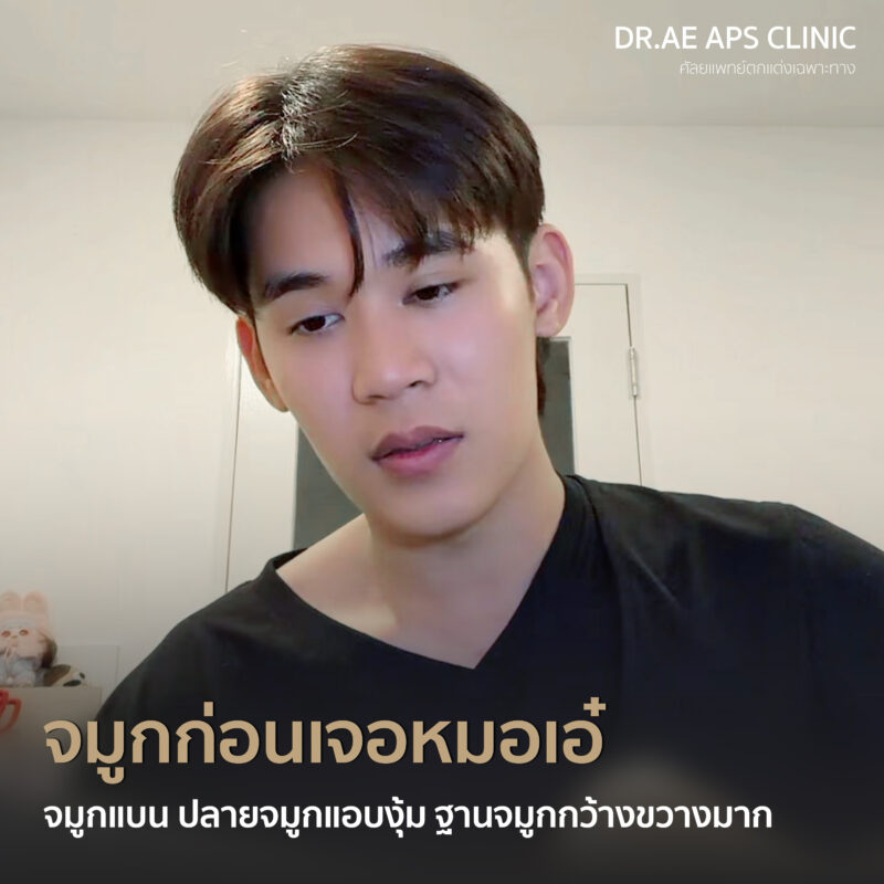 คุณฟลุ๊กรีวิวเสริมจมูกโอเพ่นซี่โครง Open rib plus+ จากคนแอบกังวล สู่คนที่ส่องกระจกทั้งวัน 2 รีวิวเสริมจมูกโอเพ่นซี่โครง คุณฟลุ๊ก