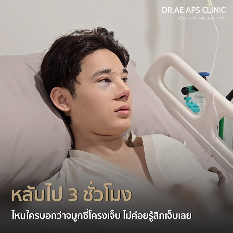 คุณฟลุ๊กรีวิวเสริมจมูกโอเพ่นซี่โครง Open rib plus+ จากคนแอบกังวล สู่คนที่ส่องกระจกทั้งวัน 3 รีวิวเสริมจมูกโอเพ่นซี่โครง คุณฟลุ๊ก