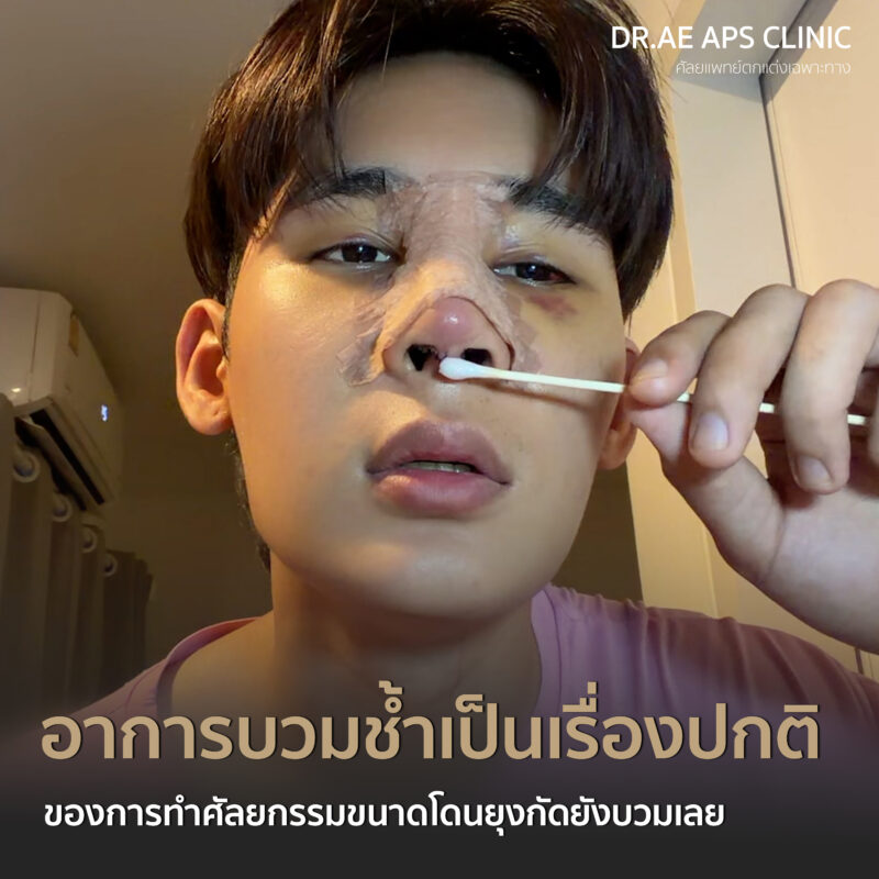 คุณฟลุ๊กรีวิวเสริมจมูกโอเพ่นซี่โครง Open rib plus+ จากคนแอบกังวล สู่คนที่ส่องกระจกทั้งวัน 4 รีวิวเสริมจมูกโอเพ่นซี่โครง คุณฟลุ๊ก