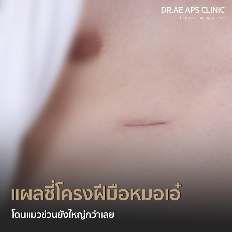 คุณฟลุ๊กรีวิวเสริมจมูกโอเพ่นซี่โครง Open rib plus+ จากคนแอบกังวล สู่คนที่ส่องกระจกทั้งวัน 5 รีวิวเสริมจมูกโอเพ่นซี่โครง คุณฟลุ๊ก