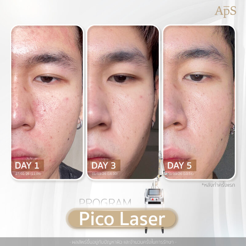 รีวิวผลลัพธ์เลเซอร์หน้าใสที่ APS Clinic