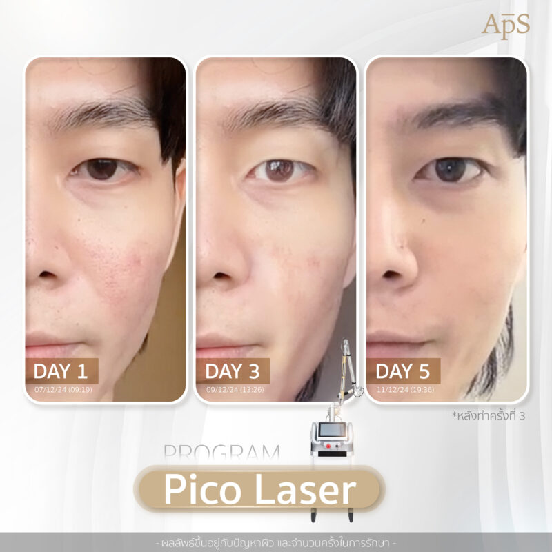 รีวิวผลลัพธ์เลเซอร์หน้าใสที่ APS Clinic