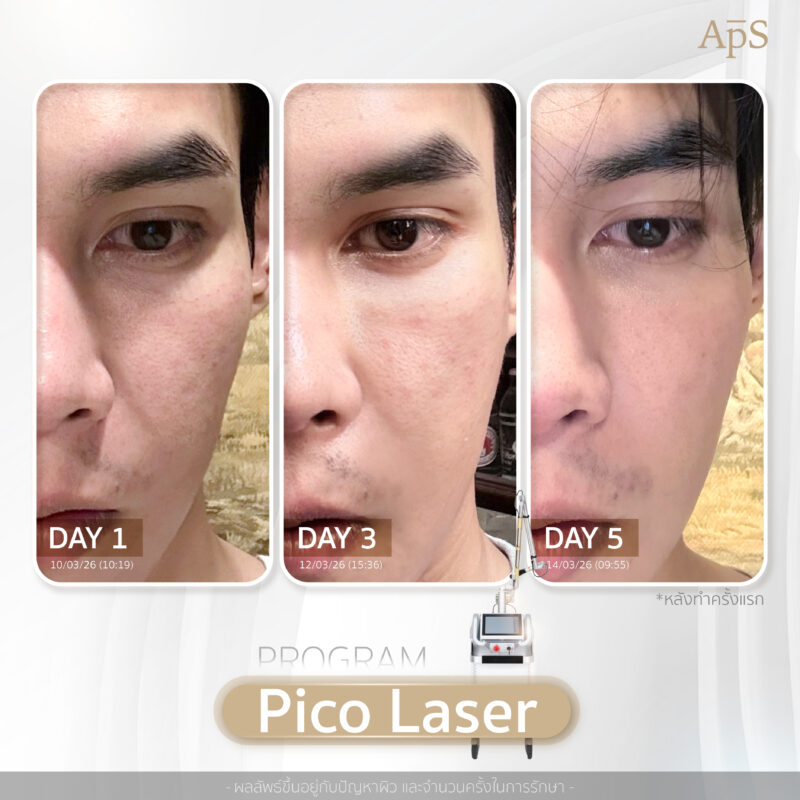 รีวิวผลลัพธ์เลเซอร์หน้าใสที่ APS Clinic