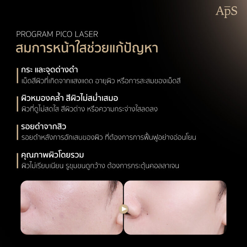 เลเซอร์หน้าใส เหมาะกับใคร