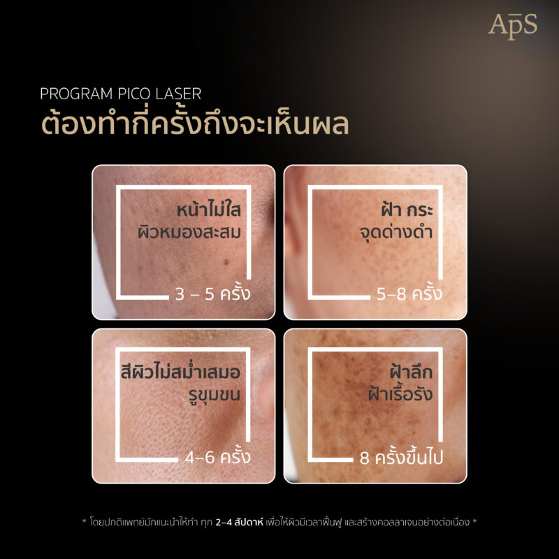 ทำเลเซอร์หน้าใส กี่ครั้งเห็นผล?