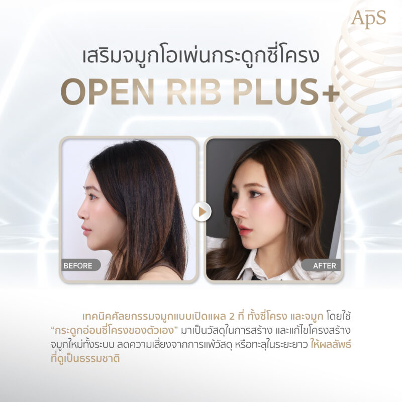 เสริมจมูกโอเพ่นกระดูกซี่โครง (Rib Cartilage Open Rhinoplasty) คืออะไร?