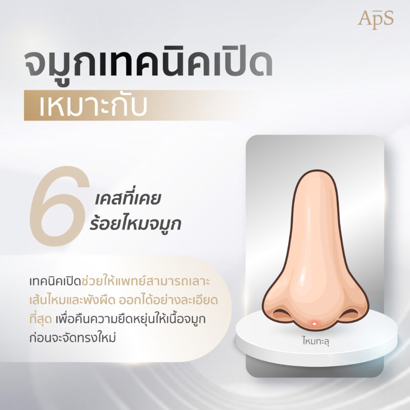 ทำจมูกเทคนิคเปิดเหมาะกับ เคสที่เคยร้อยไหมจมูก