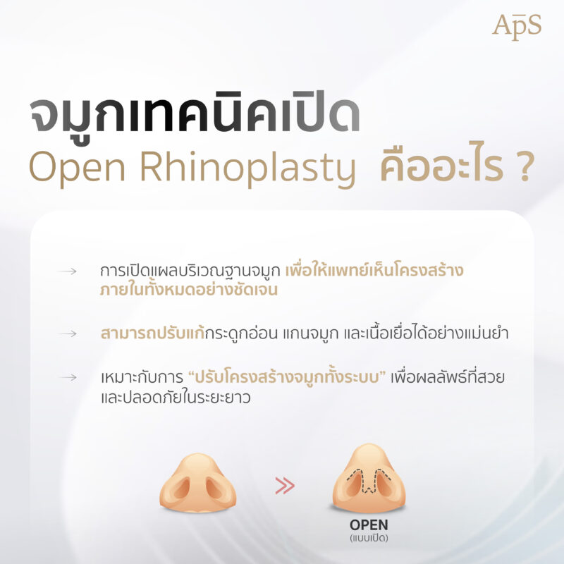 ทำจมูกเทคนิคเปิด คืออะไร