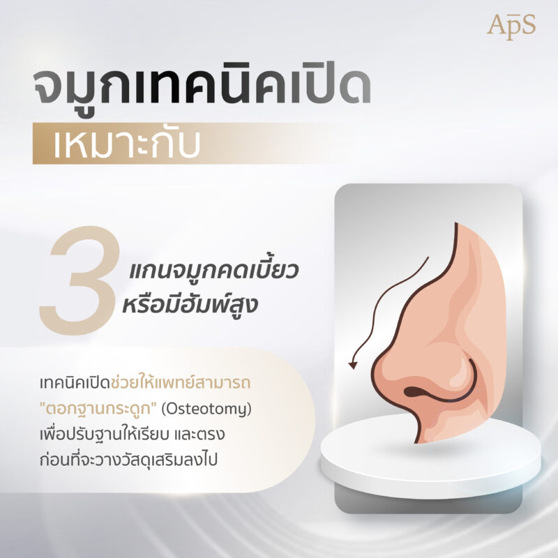 ทำจมูกเทคนิคเปิดเหมาะกับ แกนจมูกคดเบี้ยว หรือมีฮัมพ์สูง