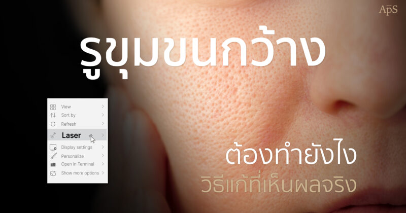 หน้าแรก 20 รูขุมขนกว้าง