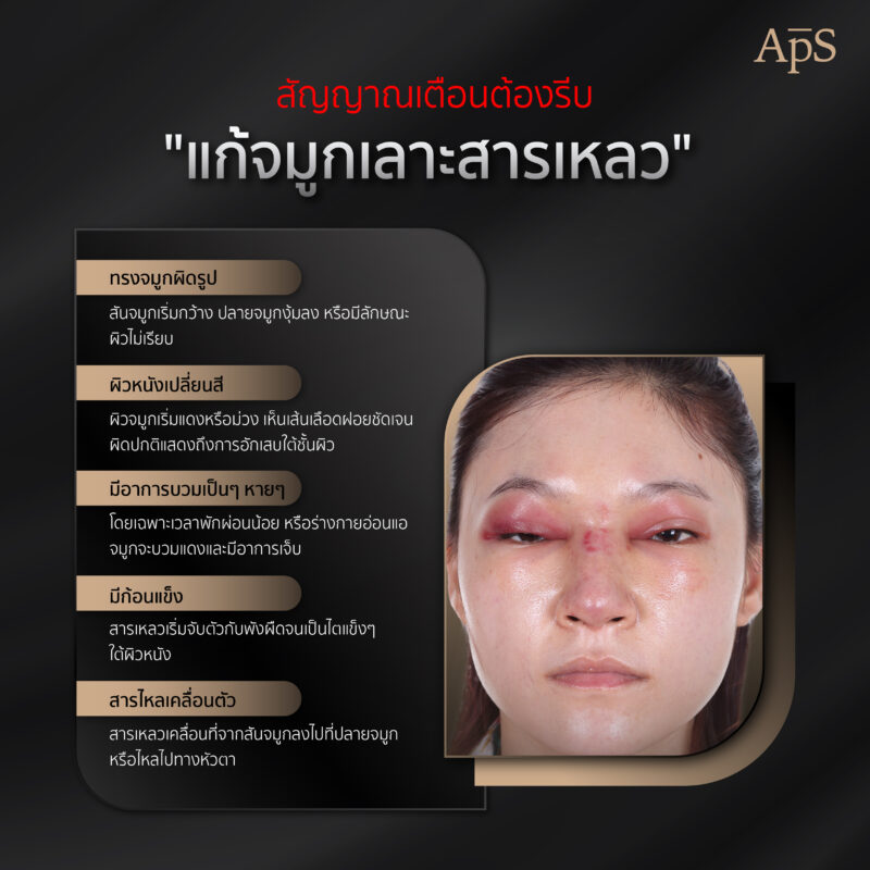 สัญญานเตือนต้องรีบ แก้จมูกเลาะสารเหลว