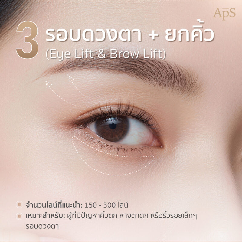 โปรแกรม Ultraformer III ยกกระชับรอบดวงตา คิ้ว