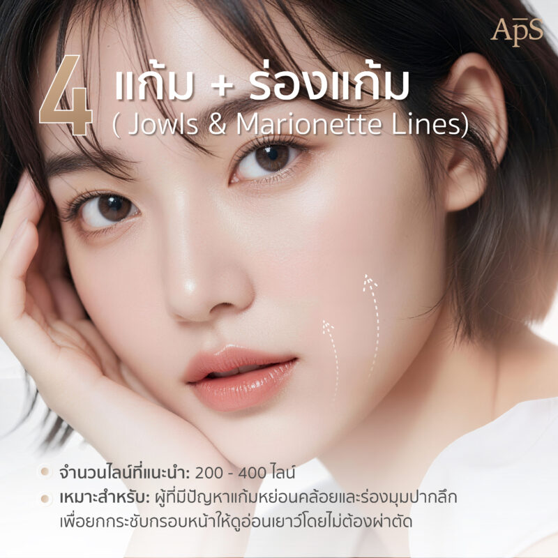 โปรแกรม Ultraformer III ยกกระชับแก้ม ร่องแก้ม