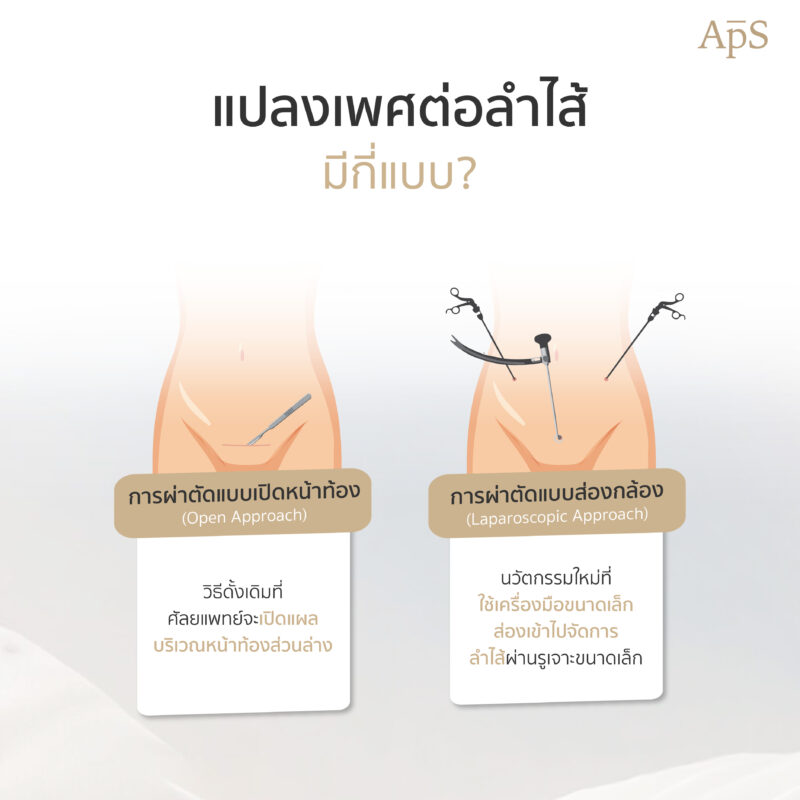 แปลงเพศต่อลำไส้มีกี่แบบ
