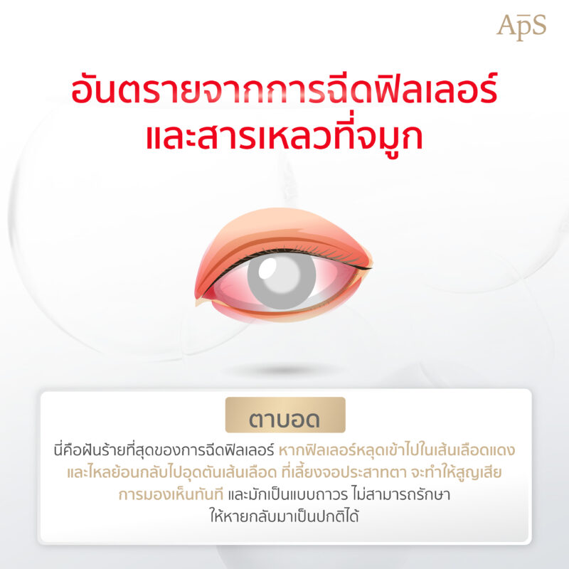 อันตรายจากการทำโปรแกรมฉีดฟิลเลอร์และสารเหลวที่จมูก ความสวยที่ต้องแลกด้วยความเสี่ยง 4 ตาบอดสนิท (Blindness)