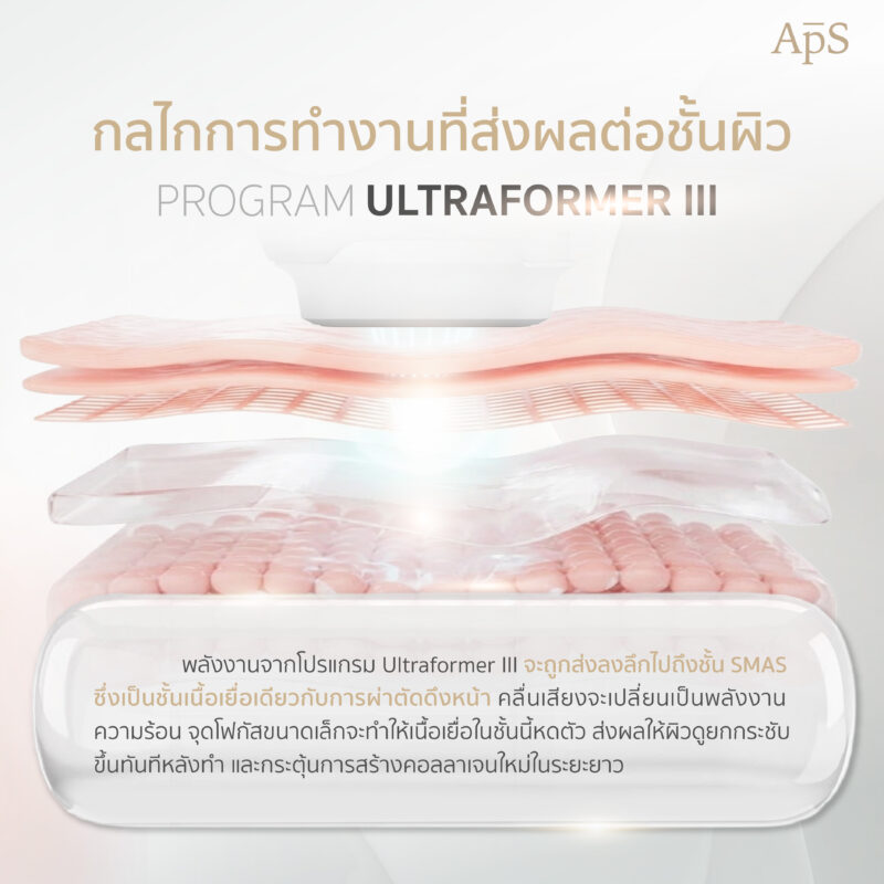 การทำงานของ Ultraformer