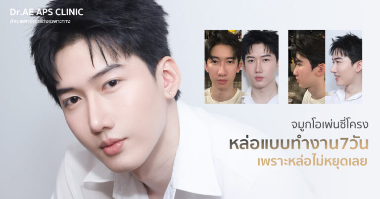 รีวิวคุณพีช ทำจมูกโอเพ่นซี่โครงครบ 1 ปี เทคนิค Open Rib Plus+