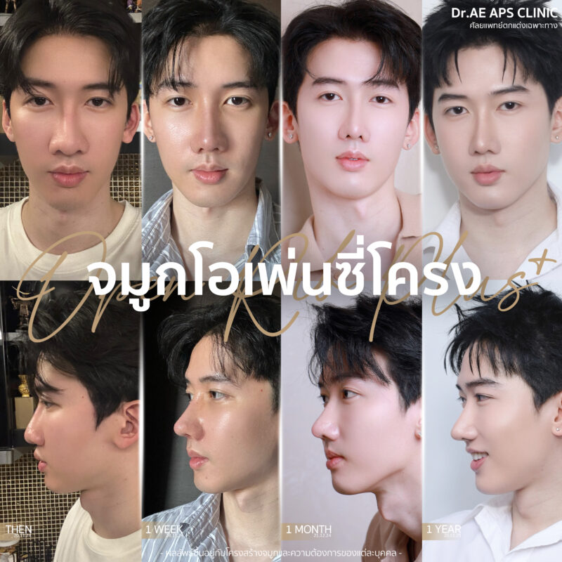 รีวิวคุณพีช ทำจมูกโอเพ่นซี่โครงครบ 1 ปี เทคนิค Open Rib Plus+ 