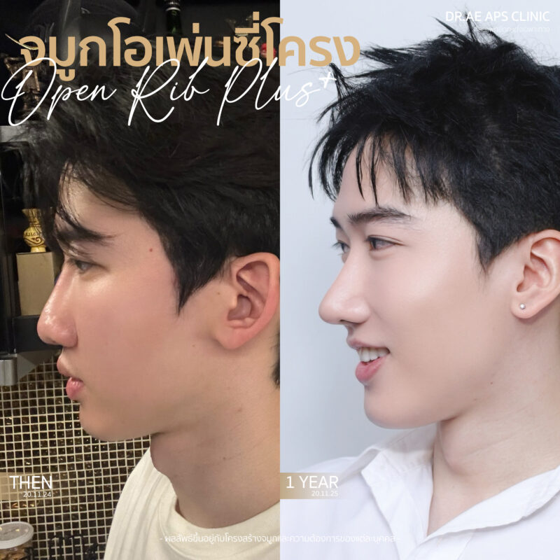 รีวิวคุณพีช ทำจมูกโอเพ่นซี่โครงครบ 1 ปี เทคนิค Open Rib Plus+ 