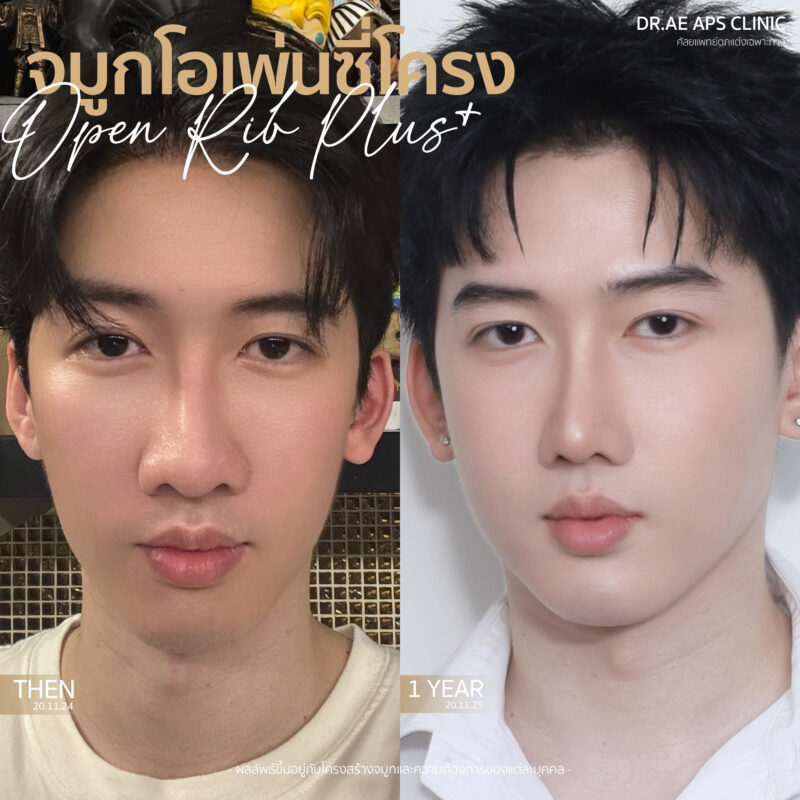 รีวิวคุณพีช ทำจมูกโอเพ่นซี่โครงครบ 1 ปี เทคนิค Open Rib Plus+ 