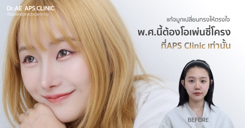 รีวิวแก้จมูกรอบที่ 4 ของมิลล์