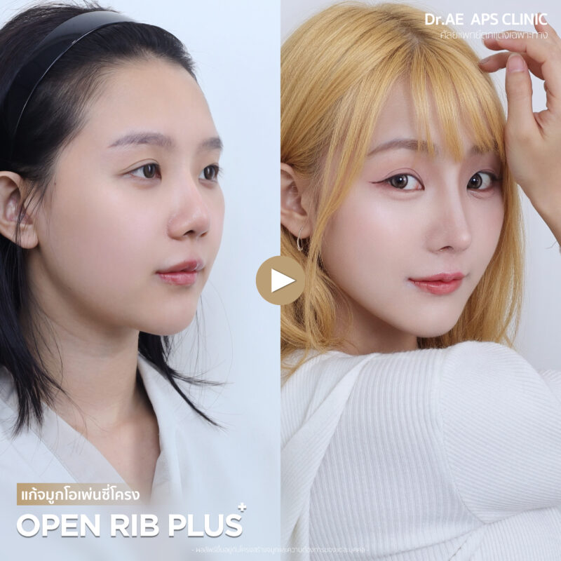 แก้จมูกรอบที่ 4 คุณมิลล์