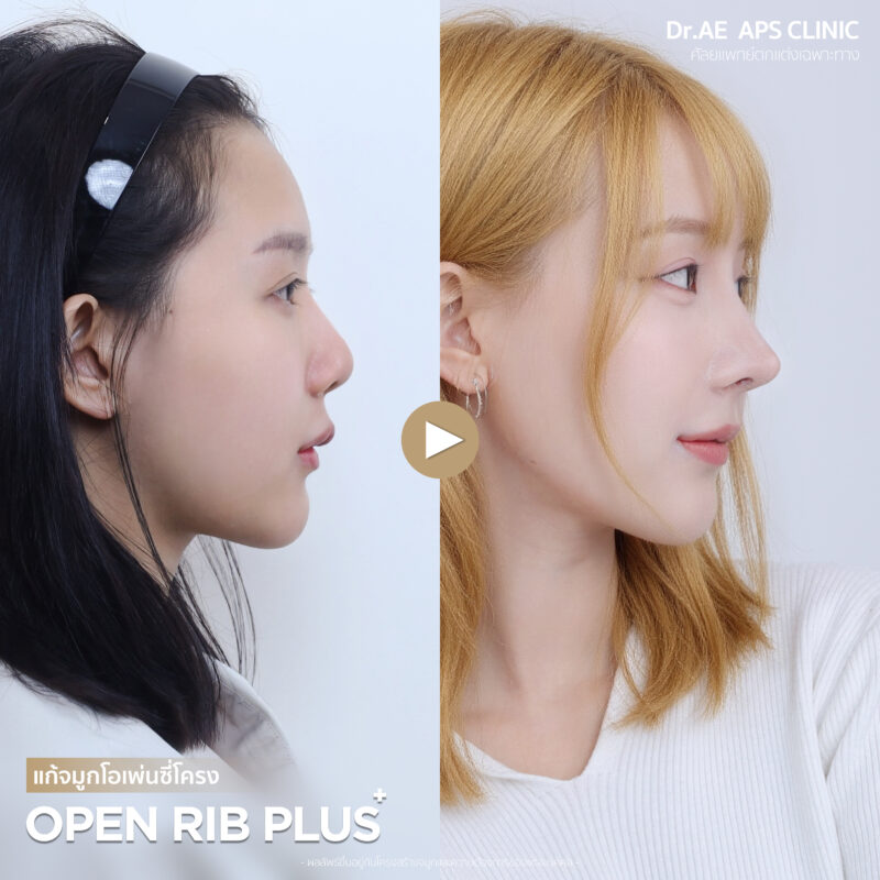 แก้จมูกรอบที่ 4 คุณมิลล์