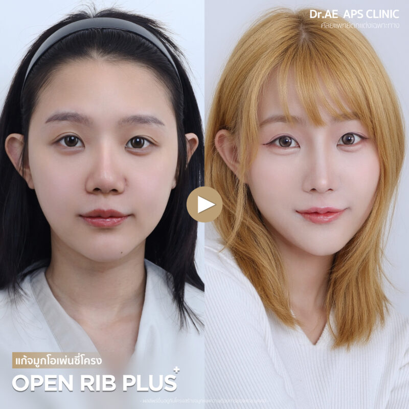 แก้จมูกรอบที่ 4 คุณมิลล์