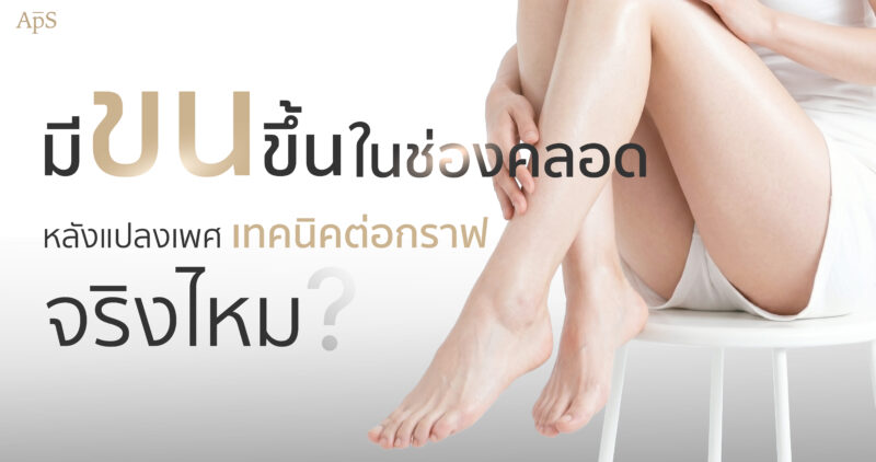 หน้าแรก 21 ขนหลังแปลงเพศต่อกราฟต์