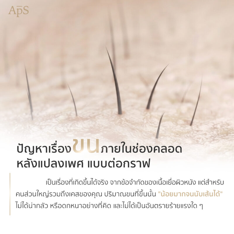 ปัญหาเรื่องขนหลังแปลงเพศต่อกราฟ ขนขึ้นได้ไหม? สิ่งที่ควรรู้ก่อนผ่าตัด 2 หลังแปลงเพศต่อกราฟ ขนขึ้นไหม?