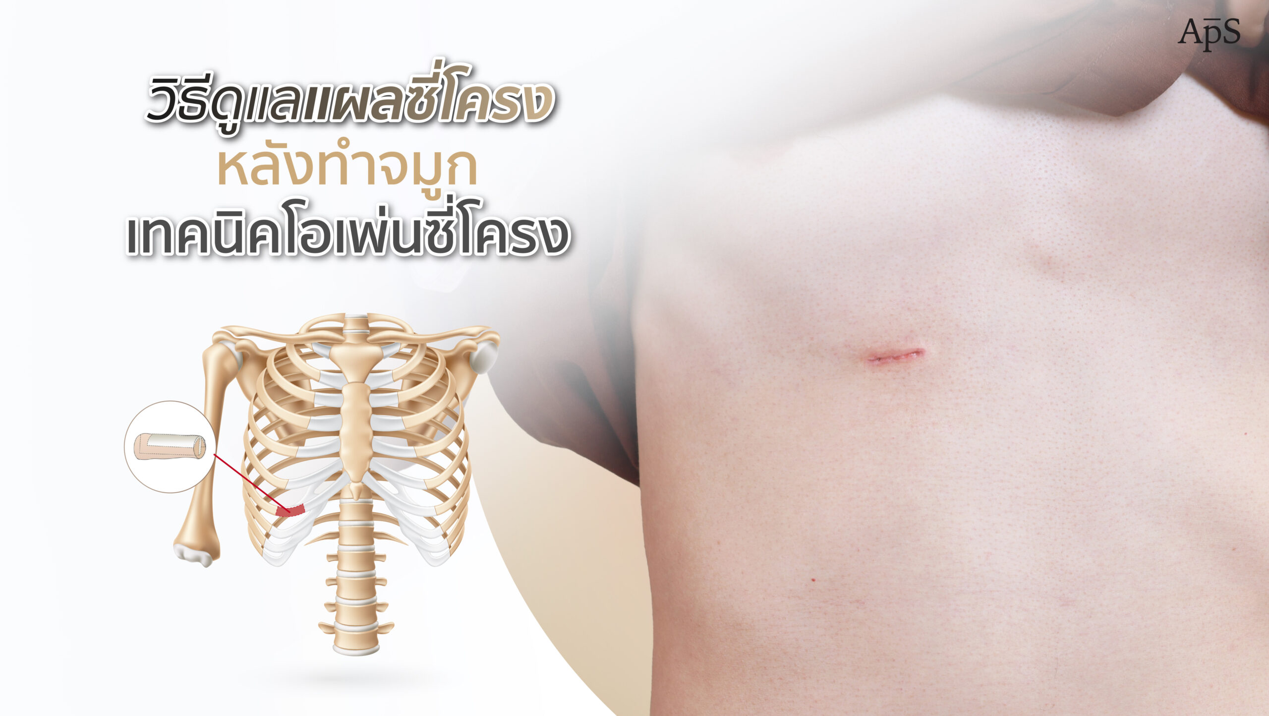 วิธีดูแลแผลซี่โครงหลังทำจมูกซี่โครงให้แผลหายเร็ว