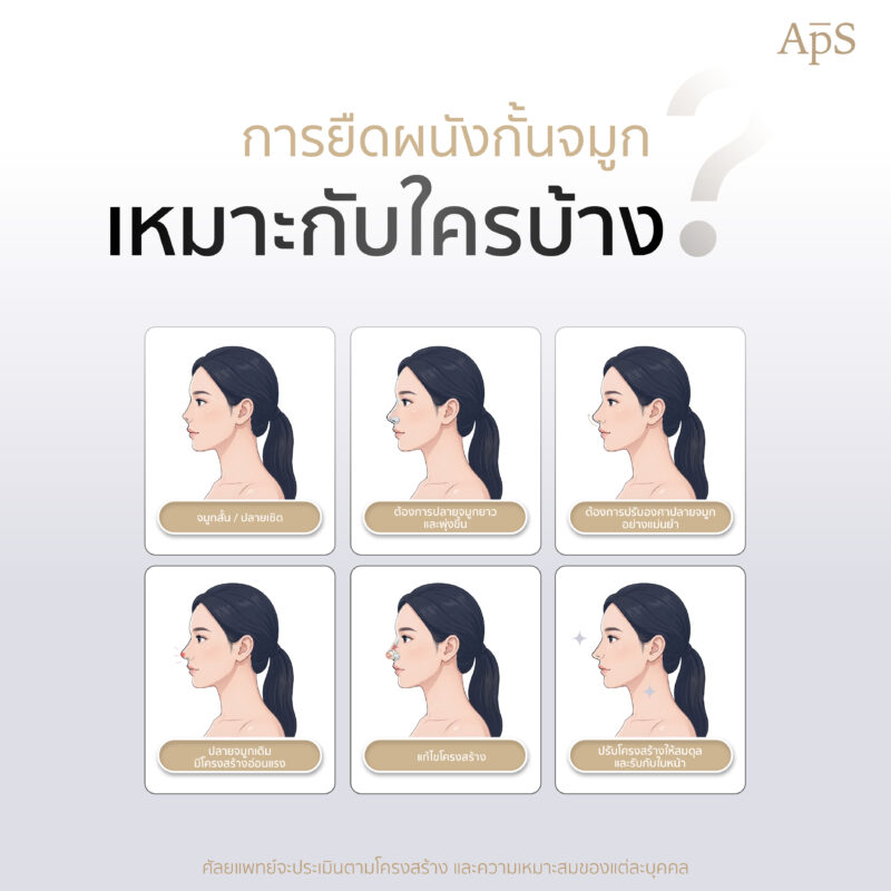 การยืดผนังกั้นจมูกคืออะไร ดีต่อการเสริมจมูกอย่างไร ผลลัพธ์เป็นอย่างไร 3 การยืดผนังกั้นจมูกเหมาะกับใครบ้าง