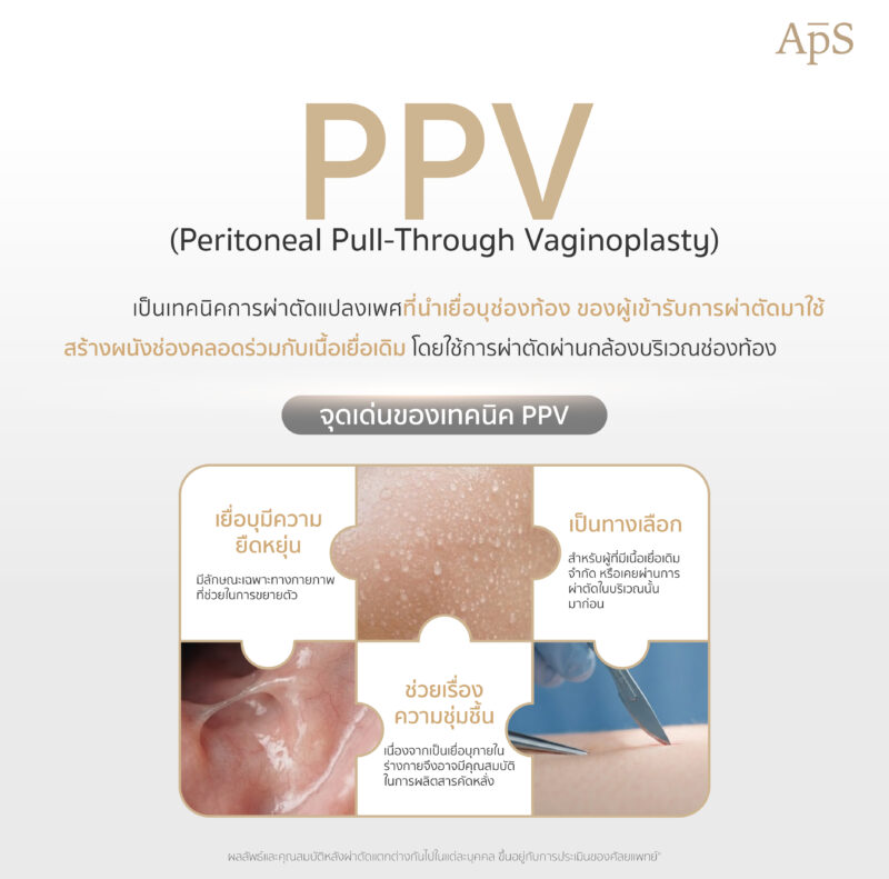 แปลงเพศเทคนิค PPV พักฟื้นนานไหม? แต่ละช่วงเวลาของการพักฟื้นเป็นอย่างไร 1 ทำความรู้จักเทคนิค PPV คืออะไร?